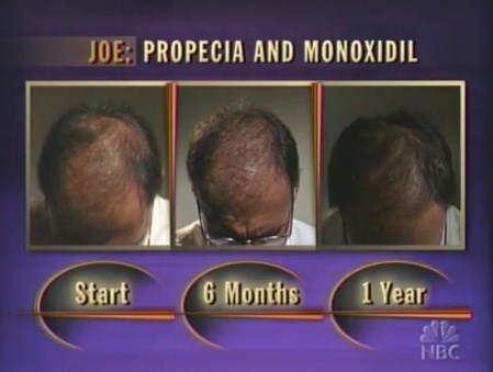 Haartransplantation und propecia